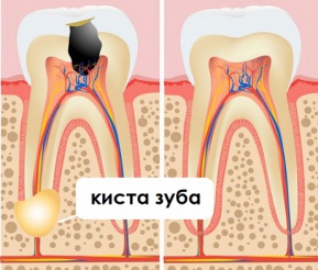 Удаление кист (цистэктомия зуба)